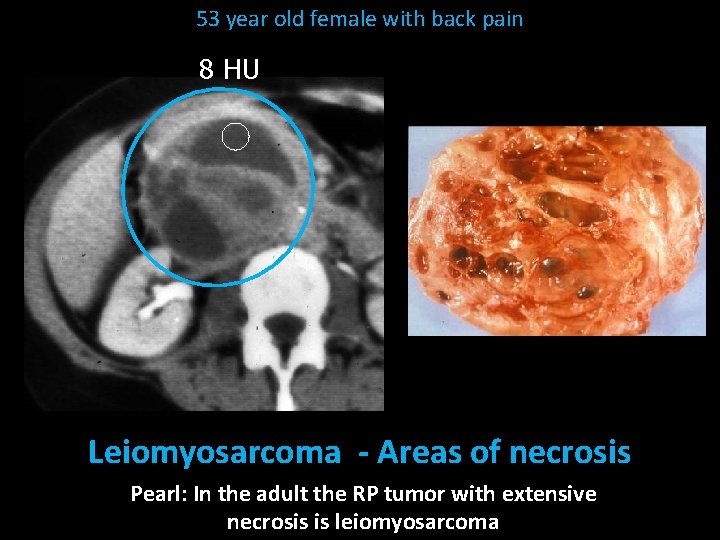 53 year old female with back pain 8 HU Leiomyosarcoma - Areas of necrosis