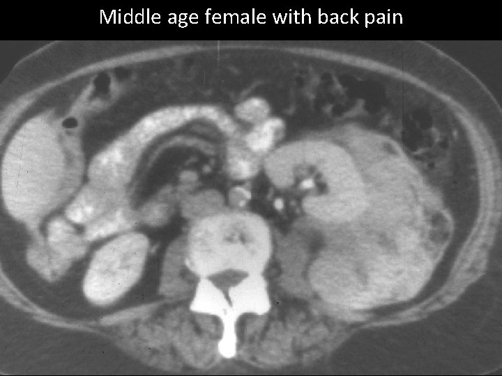Middle age female with back pain 