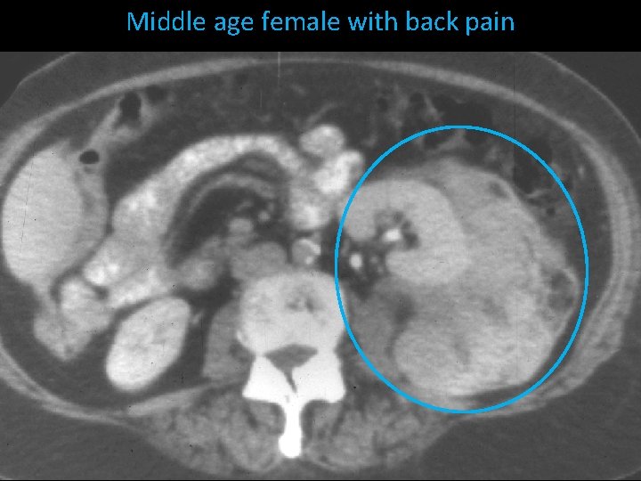 Middle age female with back pain 