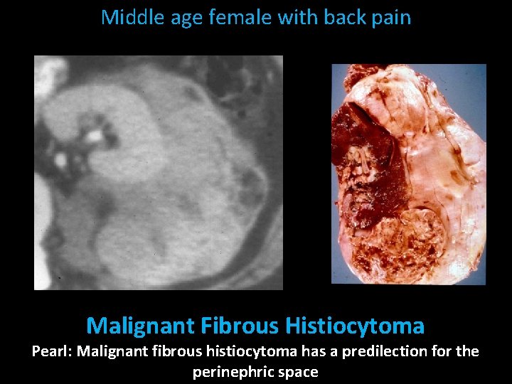 Middle age female with back pain Malignant Fibrous Histiocytoma Pearl: Malignant fibrous histiocytoma has