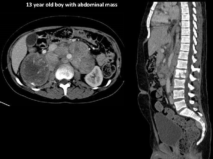 13 year old boy with abdominal mass 