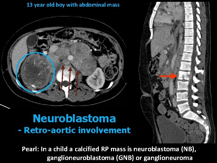 13 year old boy with abdominal mass Neuroblastoma - Retro-aortic involvement Pearl: In a