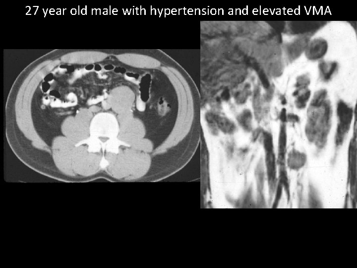 27 year old male with hypertension and elevated VMA 