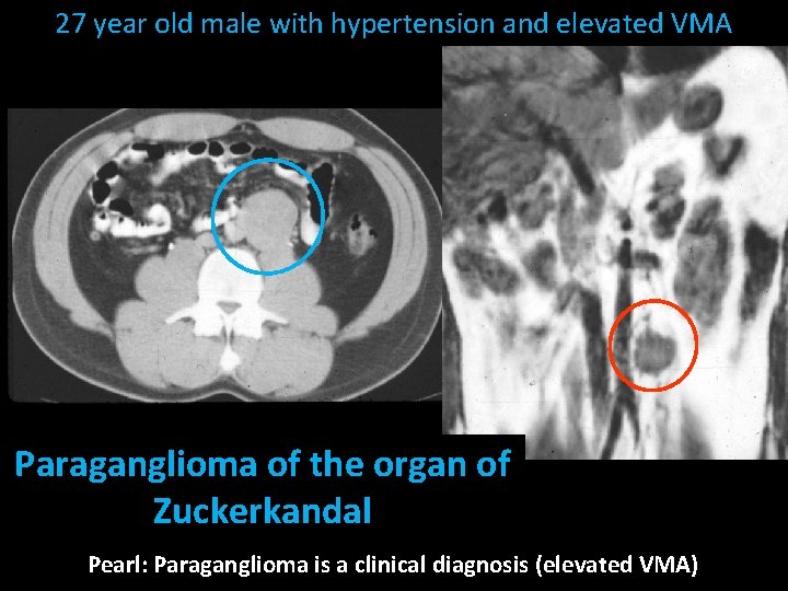 27 year old male with hypertension and elevated VMA Paraganglioma of the organ of