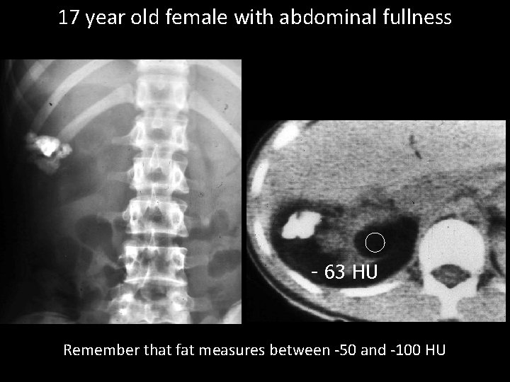 17 year old female with abdominal fullness - 63 HU Remember that fat measures