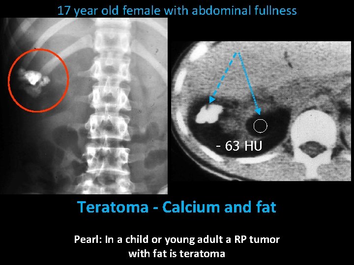 17 year old female with abdominal fullness - 63 HU Teratoma - Calcium and