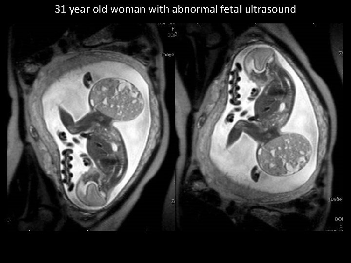 31 year old woman with abnormal fetal ultrasound 
