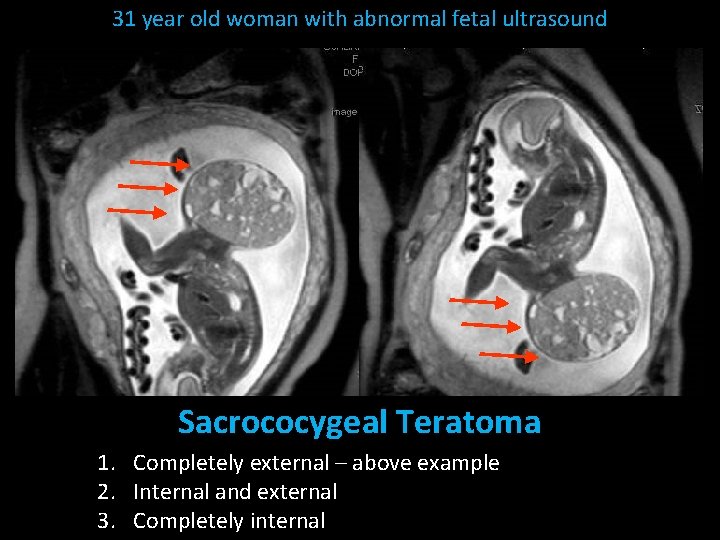 31 year old woman with abnormal fetal ultrasound Sacrococygeal Teratoma 1. Completely external –