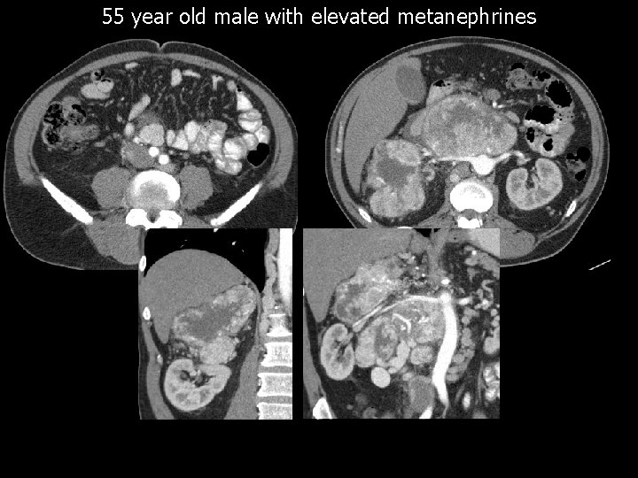 55 year old male with elevated metanephrines 