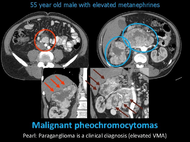 55 year old male with elevated metanephrines Malignant pheochromocytomas Pearl: Paraganglioma is a clinical