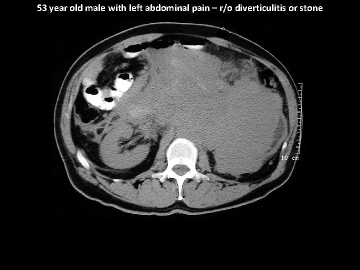 53 year old male with left abdominal pain – r/o diverticulitis or stone 