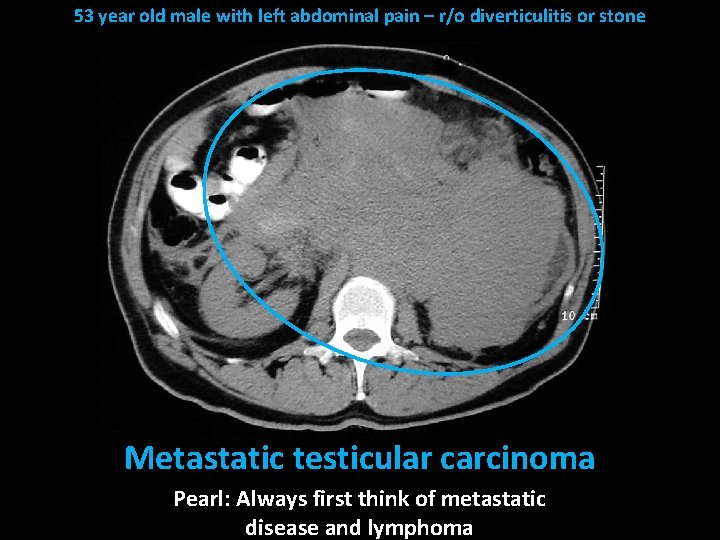 53 year old male with left abdominal pain – r/o diverticulitis or stone Metastatic