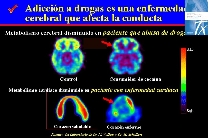Adicción a drogas es una enfermedad cerebral que afecta la conducta Metabolismo cerebral disminuido