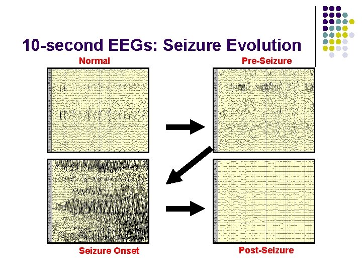 10 -second EEGs: Seizure Evolution Normal Seizure Onset Pre-Seizure Post-Seizure 