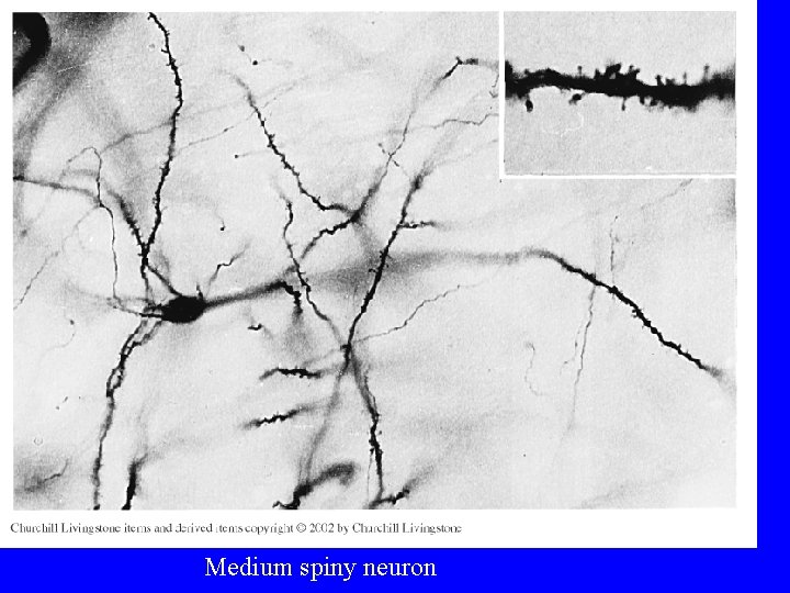 Medium spiny neuron 