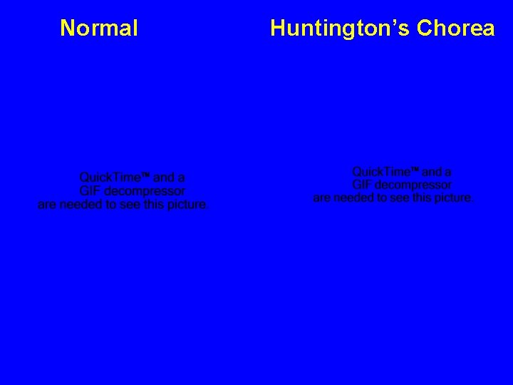 Normal Huntington’s Chorea 