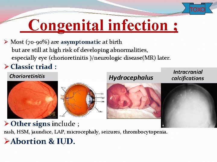 TOXO Congenital infection ; Ø Most (70 -90%) are asymptomatic at birth but are