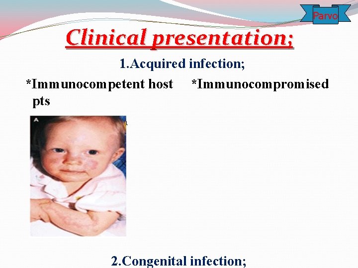 Parvo Clinical presentation; 1. Acquired infection; *Immunocompetent host *Immunocompromised pts Erythema infectiosum 2. Congenital