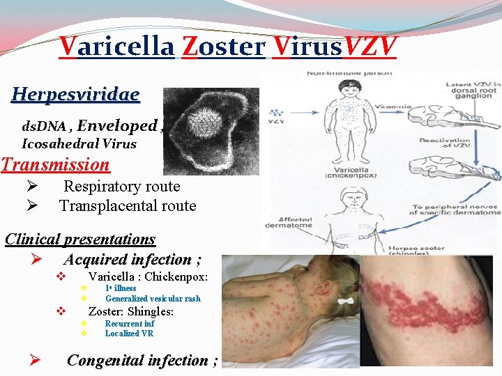 Varicella Zoster Virus. VZV Herpesviridae ds. DNA , Enveloped , Icosahedral Virus Transmission Ø