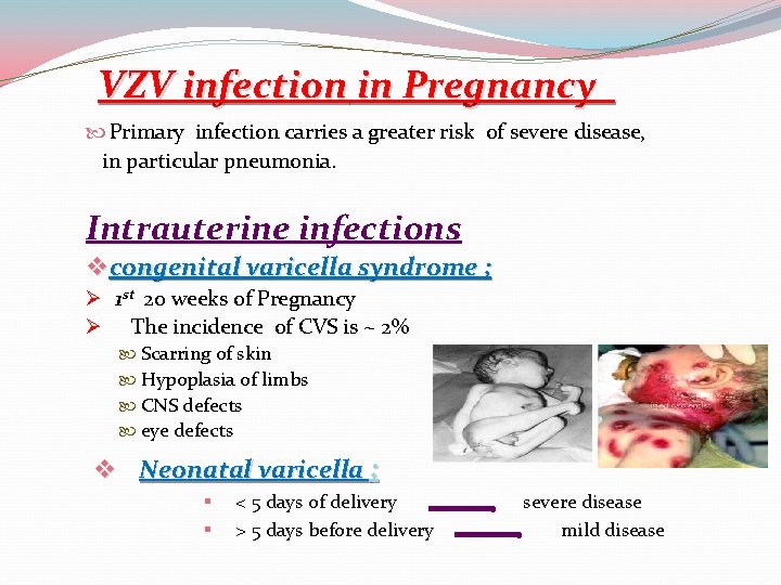 VZV infection in Pregnancy Primary infection carries a greater risk of severe disease, in