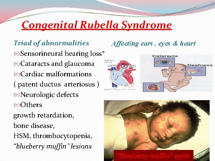 Congenital Rubella Syndrome Triad of abnormalities Affecting ears , eyes & heart Sensorineural hearing