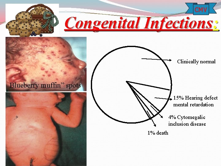 CMV Congenital Infections: Clinically normal Blueberry muffin” spots 15% Hearing defect mental retardation 4%