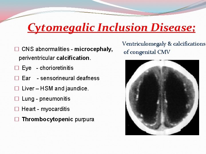 Cytomegalic Inclusion Disease; � CNS abnormalities - microcephaly, periventricular calcification. � Eye - chorioretinitis