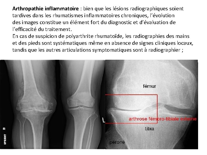 Arthropathie inflammatoire : bien que les lésions radiographiques soient tardives dans les rhumatismes inflammatoires