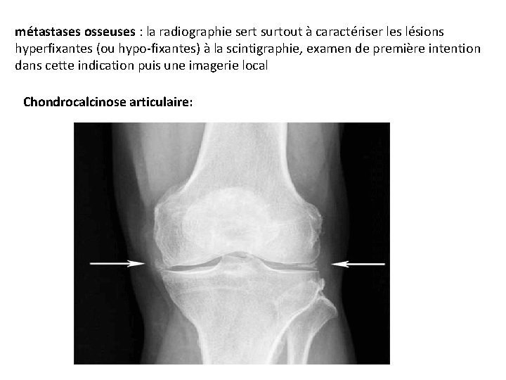 métastases osseuses : la radiographie sert surtout à caractériser les lésions hyperfixantes (ou hypo-fixantes)