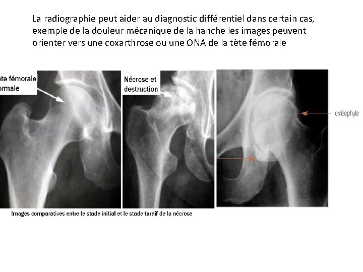 La radiographie peut aider au diagnostic différentiel dans certain cas, exemple de la douleur