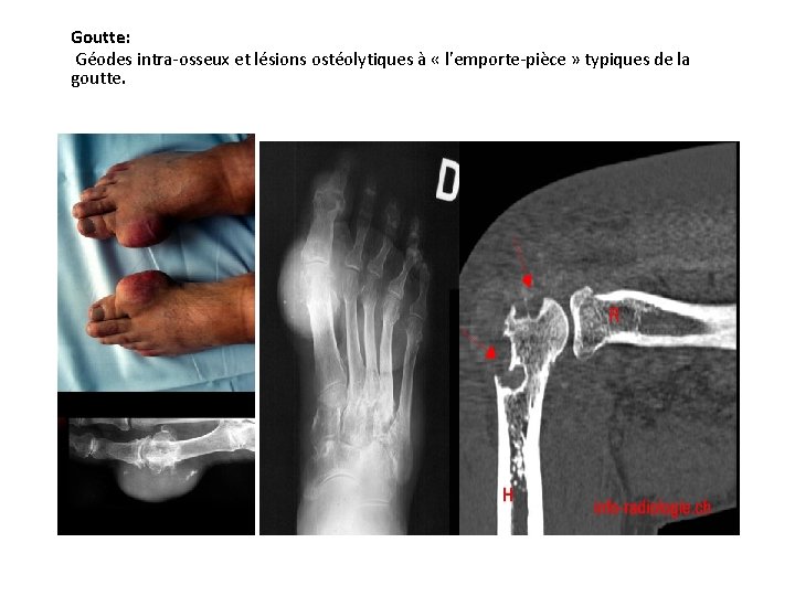 Goutte: Géodes intra-osseux et lésions ostéolytiques à « l’emporte-pièce » typiques de la goutte.
