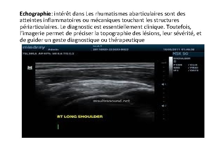 Echographie: intérêt dans Les rhumatismes abarticulaires sont des atteintes inflammatoires ou mécaniques touchant les