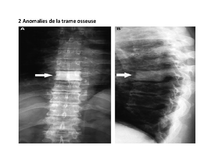 2 Anomalies de la trame osseuse 