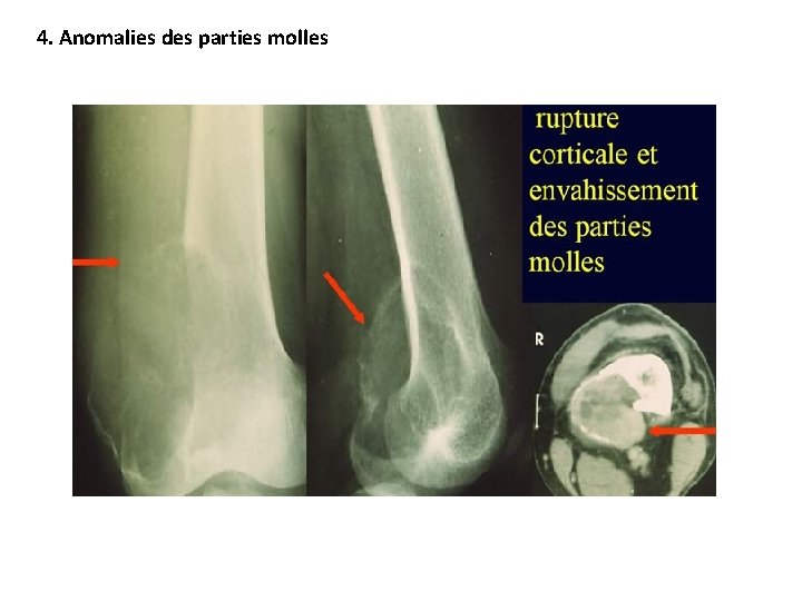 4. Anomalies des parties molles 