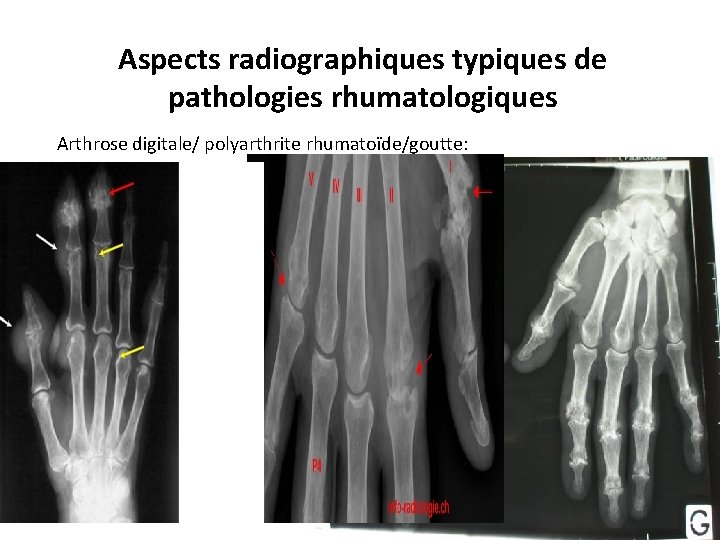 Aspects radiographiques typiques de pathologies rhumatologiques Arthrose digitale/ polyarthrite rhumatoïde/goutte: 