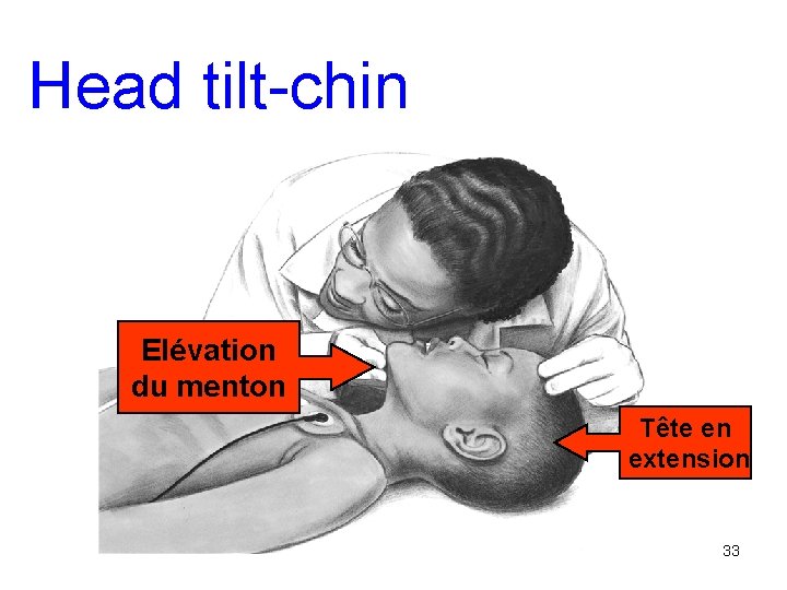 Head tilt-chin Elévation du menton Tête en extension 33 