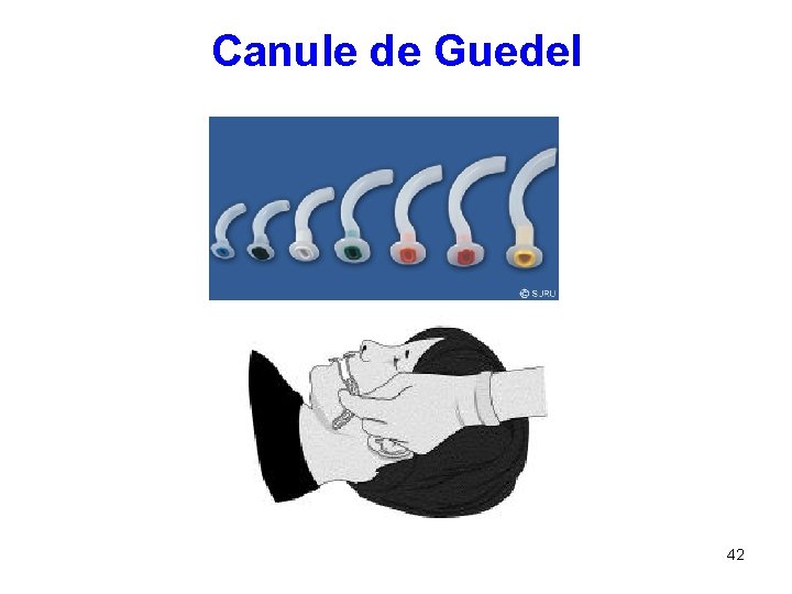 Canule de Guedel 42 