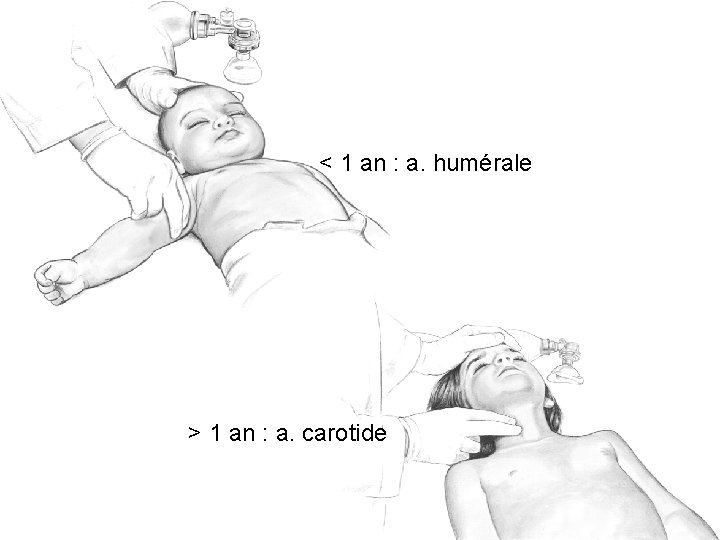 < 1 an : a. humérale > 1 an : a. carotide 69 