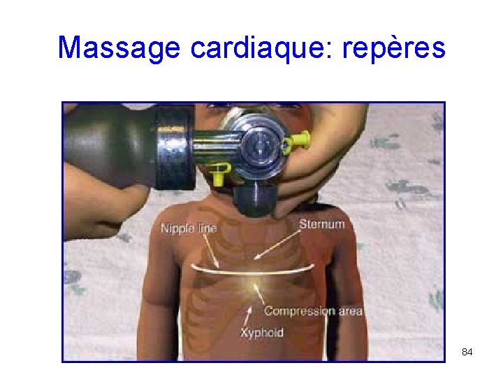 Massage cardiaque: repères 84 