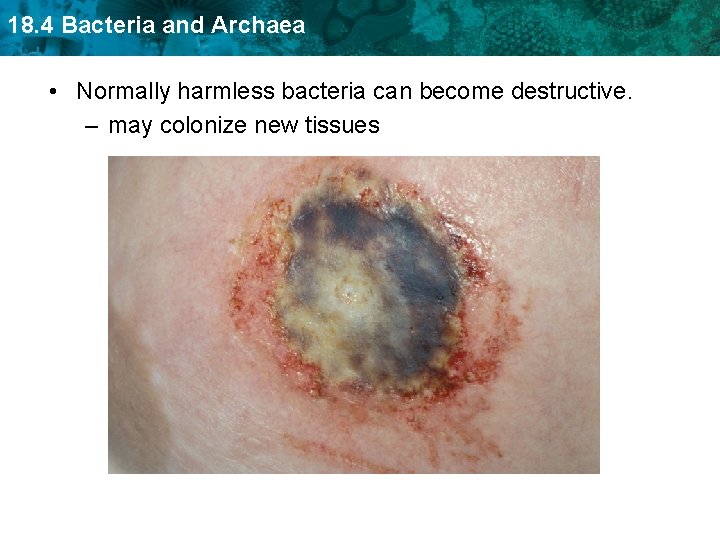 18. 4 Bacteria and Archaea • Normally harmless bacteria can become destructive. – may