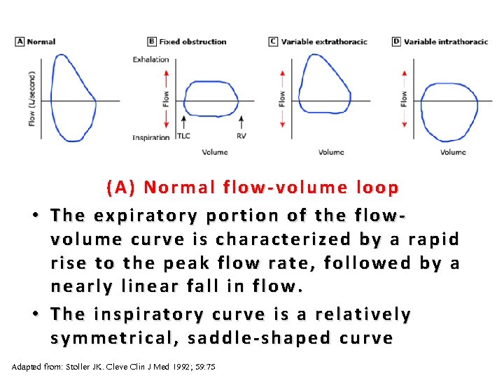 32 (A) Normal flow-volume loop • The expiratory portion of the flowvolume curve is