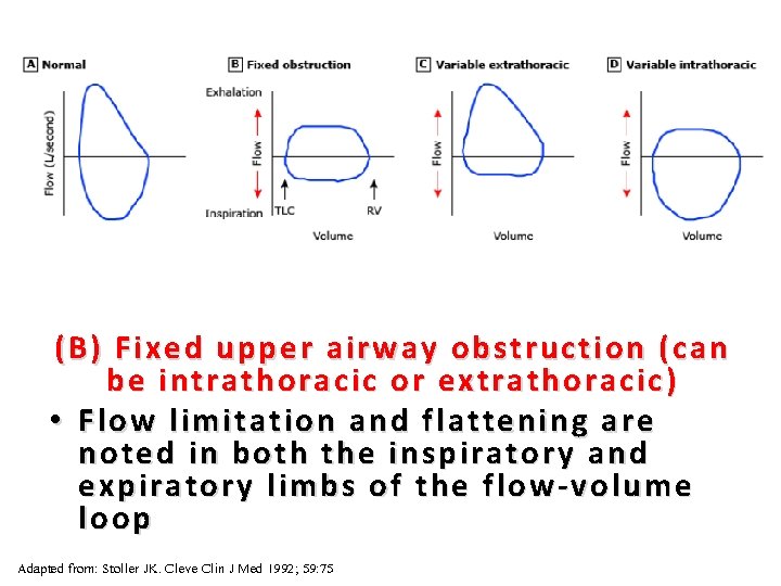 33 (B) Fixed upper airway obstruction (can be intrathoracic or extrathoracic ) • Flow