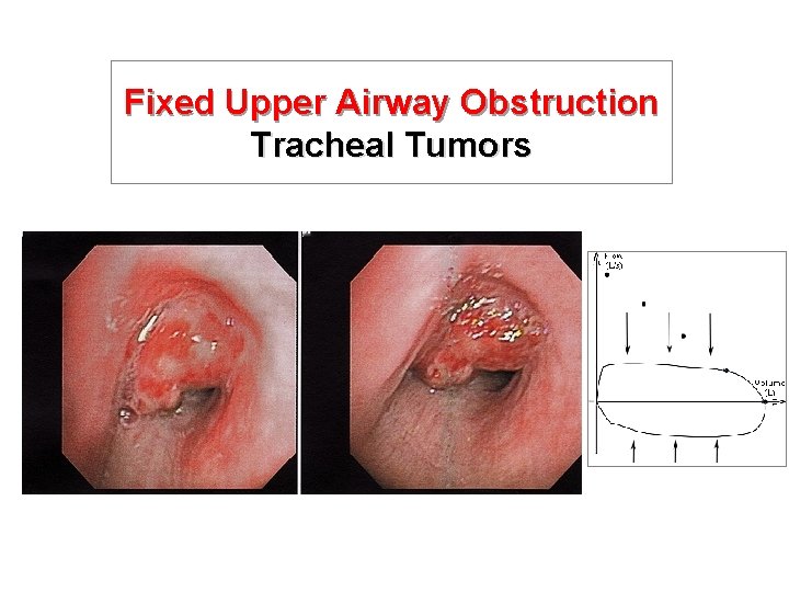 Fixed Upper Airway Obstruction Tracheal Tumors 