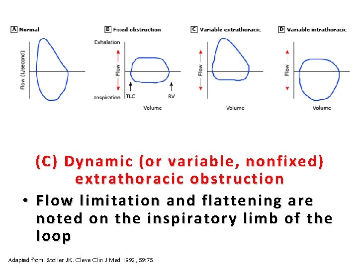 35 (C ) Dynamic (or variable, nonfixed) extrathoracic obstruction • Flow limitation and flattening