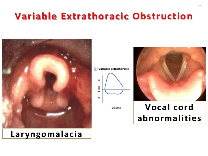36 Variable Extrathoracic Obstruction Vocal cord abnormalities Laryngomalacia 