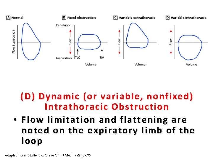 37 (D) Dynamic (or variable, nonfixed) Intrathoracic Obstruction • Flow limitation and flattening are