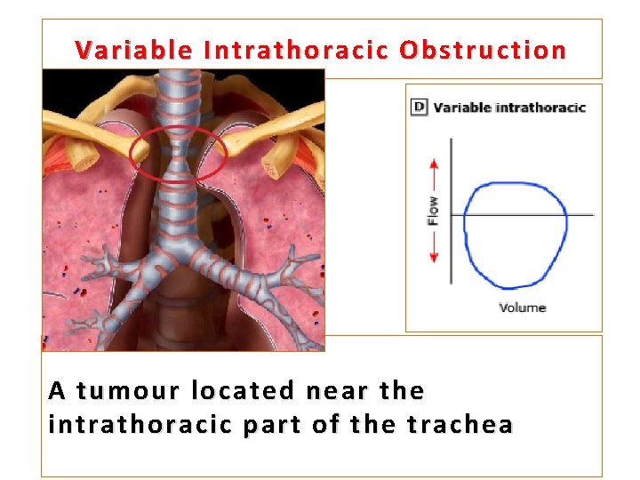 Variable Intrathoracic Obstruction A tumour located near the intrathoracic part of the trachea 