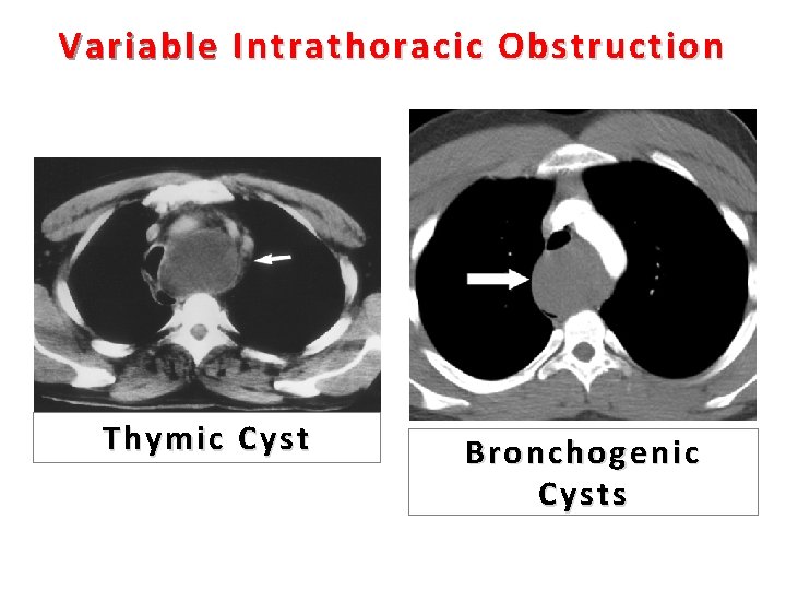 Variable Intrathoracic Obstruction Thymic Cyst Bronchogenic Cysts 