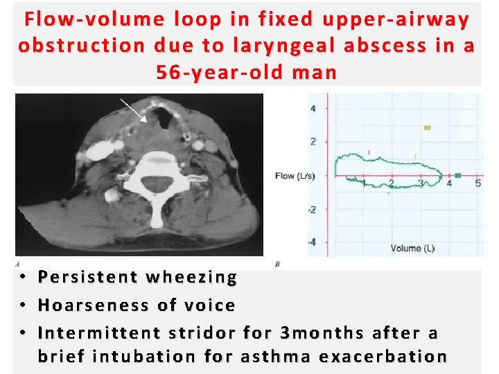 Flow-volume loop in fixed upper-airway obstruction due to laryngeal abscess in a 56 -year-old