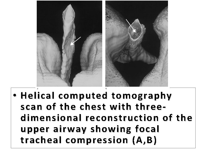  • Helical computed tomography scan of the chest with threedimensional reconstruction of the